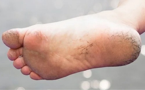 পা ফাটা রোধে ঘরোয়া সমাধান 