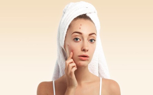 শীতে ব্রণ বেড়ে গেছে? জেনে নিন সমাধান 