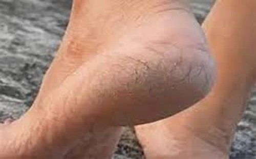 পা ফাটা সাড়াতে করণীয় 