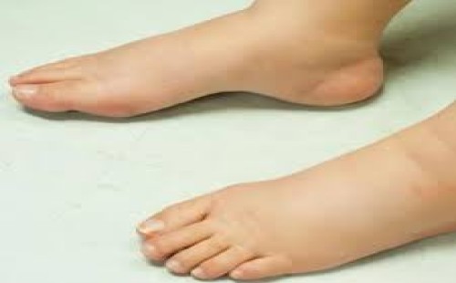 পা ফোলা কীসের লক্ষ্মণ? 