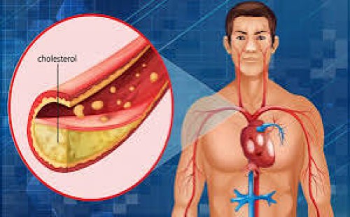 উচ্চ কোলেস্টেরলের কিছু লক্ষ্মণ 
