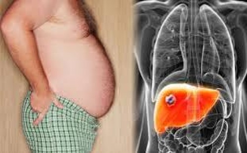 ফ্যাটি লিভার হলে যা করবেন 