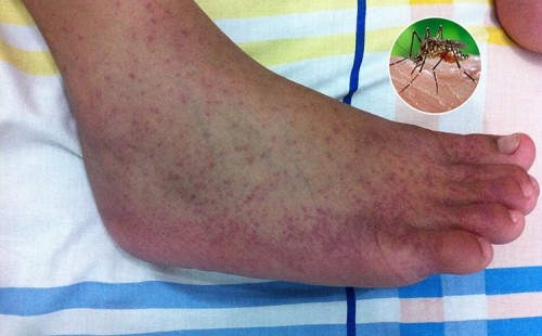 ইউরোপে স্থায়ী ডেঙ্গু ও চিকুনগুনিয়া 