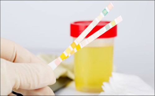 সকালে প্রস্রাব হলুদ হওয়া: স্বাভাবিক নাকি কোনো রোগের লক্ষণ? 